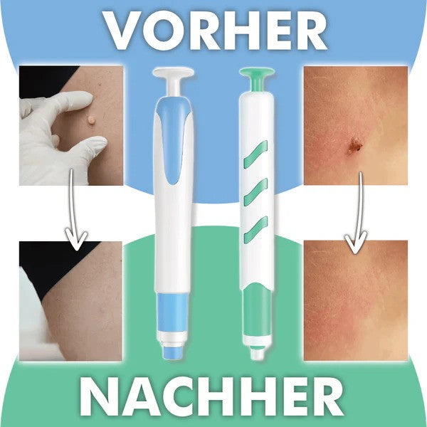 Dopiv Wart-Free PRO - The Professional Wart Remover