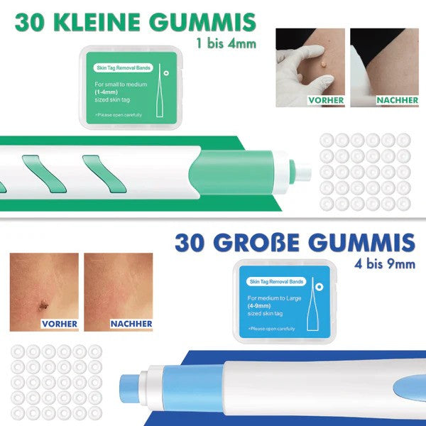 Dopiv Wart-Free PRO - The Professional Wart Remover